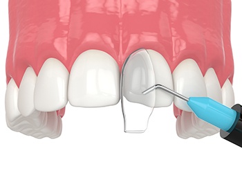 Illustration of cosmetic dental bonding in Midland for upper arch of teeth