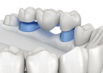 Digital image of a traditional dental bridge