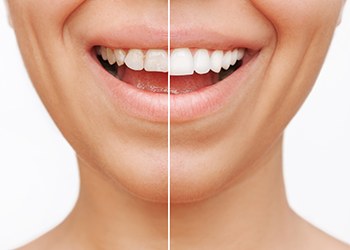 Closeup of patient's smile before and after veneers