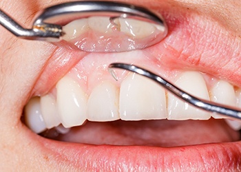 Closeup of someone’s gums being cleaned with dental instrument